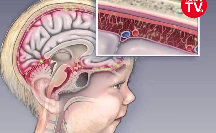 ЦАХИЛГААН МЕНИНГИТИЙН ЭРСДЭЛ ӨНДӨР УЛИРАЛ ЭХЭЛЖ БАЙНА