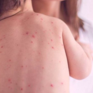 Улаан бурхан өвчний тохиолдол улсын хэмжээнд 14’365 бүртгэгдэж нас баралтын тоо 15 хүрлээ.