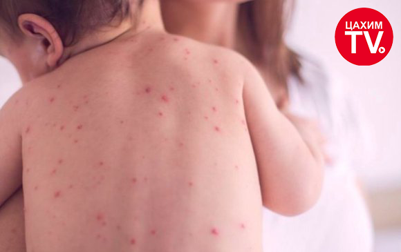 Улаан бурхан өвчний тохиолдол улсын хэмжээнд 14’365 бүртгэгдэж нас баралтын тоо 15 хүрлээ.